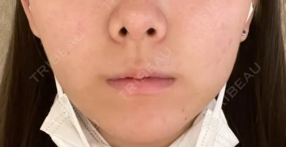 脂肪吸引（顔） Mods Clinic（モッズクリニック） 東京院 DAY 6 メイン用