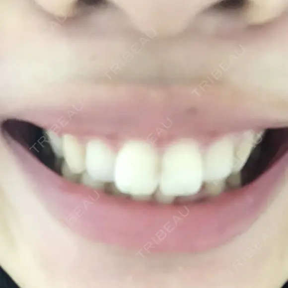 ガミースマイル手術 有楽町美容外科クリニック DAY 5 メイン用