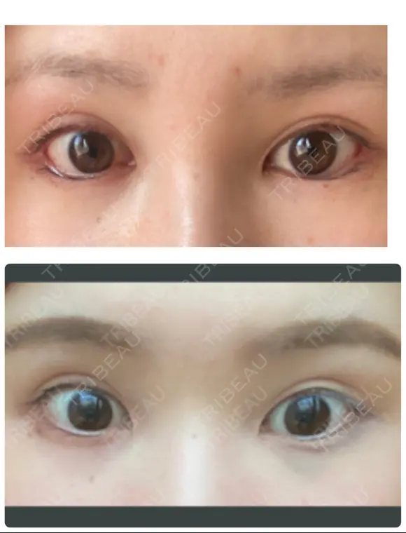 目尻切開 / タレ目形成・グラマラスライン（切開） ビスポーククリニック 福岡院 DAY 21 メイン用