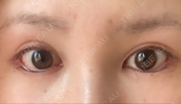 目尻切開 / タレ目形成・グラマラスライン（切開） ビスポーククリニック 福岡院 DAY 21 メイン用