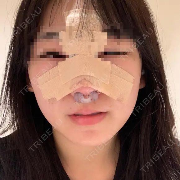 鼻尖形成（切開） / 鼻中隔延長（切開） / 軟骨移植 / その他（鼻） KAUNIS CLINIC（カウニスクリニック） DAY 2 メイン用