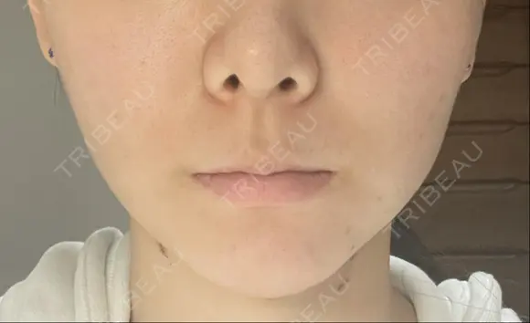 脂肪吸引（顔） Mods Clinic（モッズクリニック） 東京院 DAY 7 メイン用