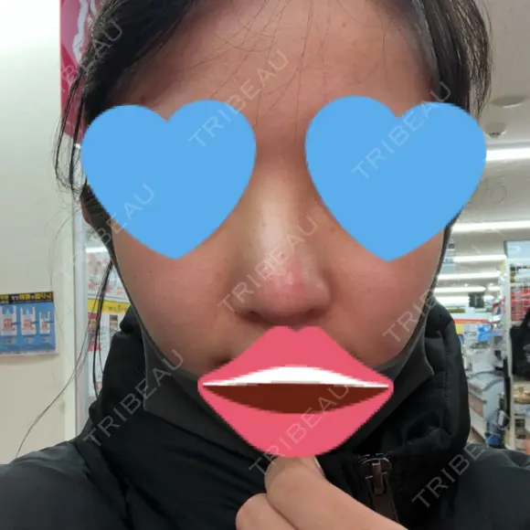 プロテーゼ除去 四谷見附クリニック DAY 0 メイン用