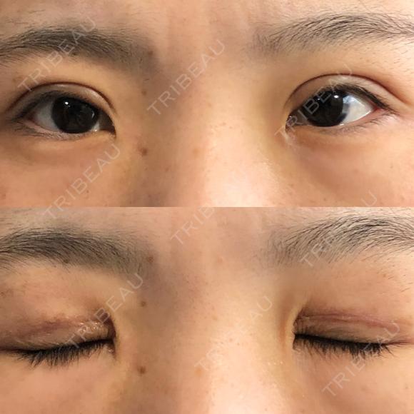 二重切開 城本クリニック 福岡院 DAY 38 メイン用