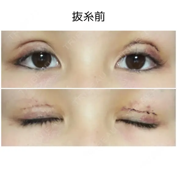 二重切開 / 上まぶたたるみ取り / 目元修正 サラ美容外科 DAY 6 メイン用