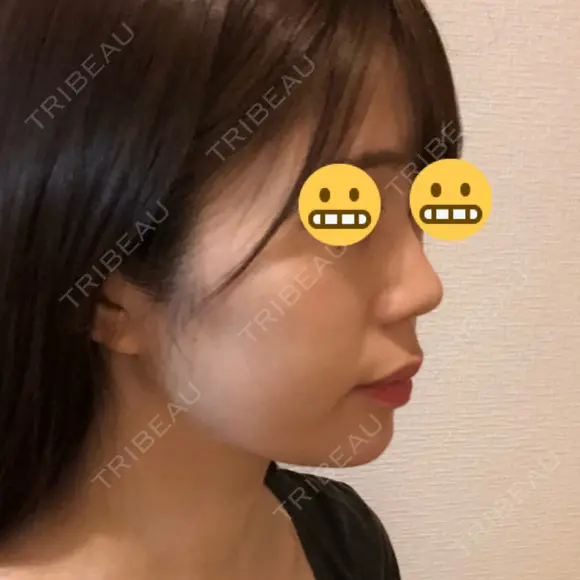 ヒアルロン酸注入（あご） 東京ヒルズクリニック 新宿院 DAY 0 メイン用