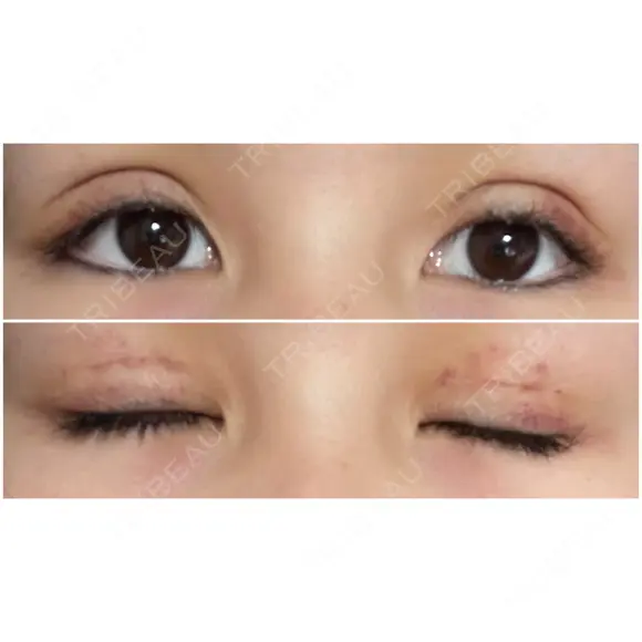 二重切開 / 上まぶたたるみ取り / 目元修正 サラ美容外科 DAY 7 メイン用