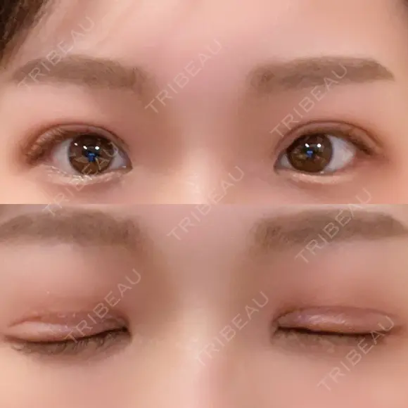 二重切開 EMMA CLINIC（エマクリニック） DAY 41 メイン用