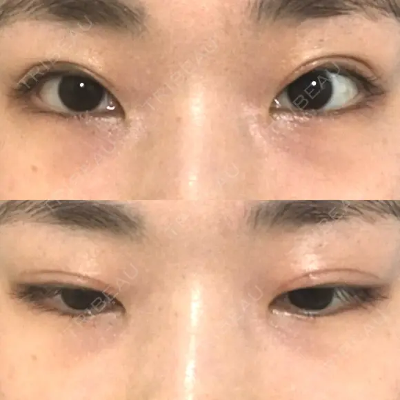 二重切開 / 上まぶたの脂肪取り 松下皮フ形成外科 DAY 46 メイン用