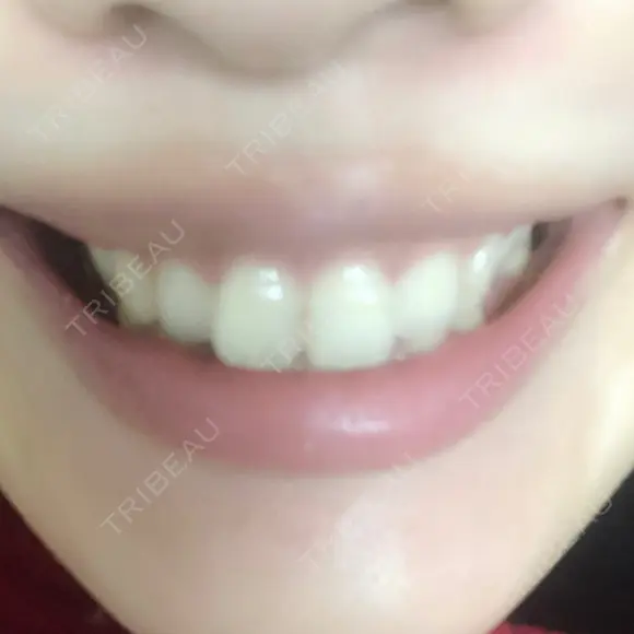 ガミースマイル手術 有楽町美容外科クリニック DAY 5 メイン用