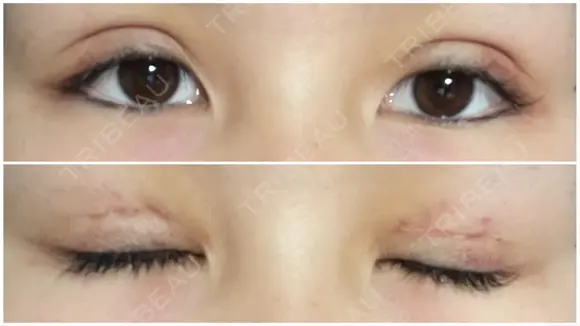 二重切開 / 上まぶたたるみ取り / 目元修正 サラ美容外科 DAY 8 メイン用