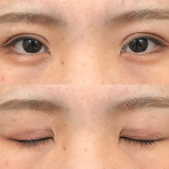 二重切開 城本クリニック 福岡院 DAY 41 メイン用