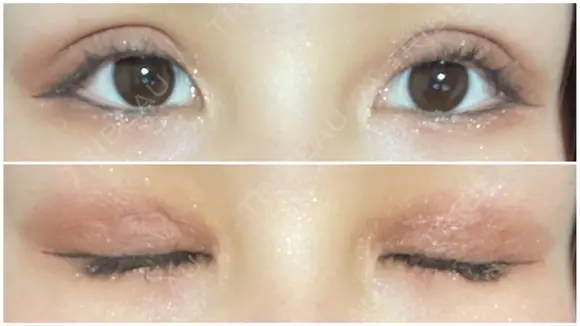 二重切開 / 上まぶたたるみ取り / 目元修正 サラ美容外科 DAY 9 メイン用