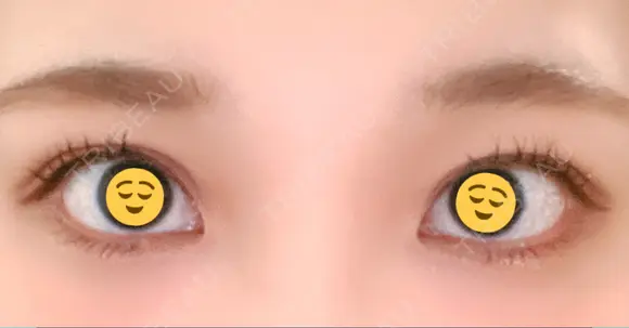 二重埋没 湘南美容クリニック 金沢院 AFTER メイン用