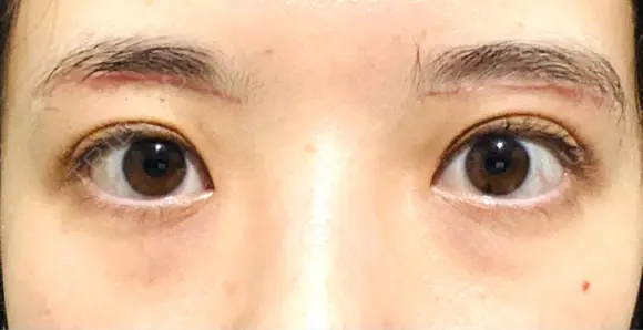 眉下切開 Taide Suenaga Clinic（タイデスエナガクリニック） DAY 50 メイン用