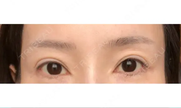 アートメイク（眉） GRACIA clinic 【グラシアクリニック】 DAY 83 メイン用