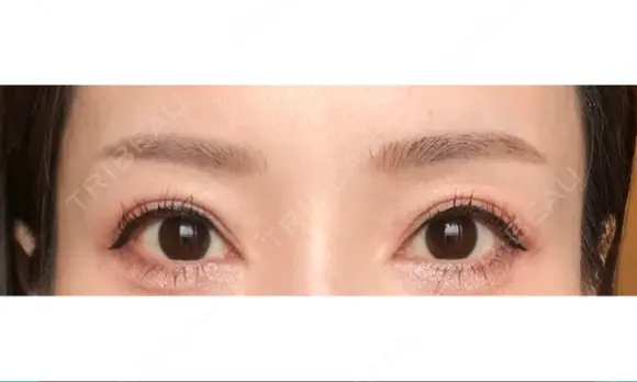 アートメイク（眉） GRACIA clinic 【グラシアクリニック】 DAY 83 メイン用