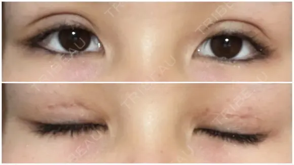 二重切開 / 上まぶたたるみ取り / 目元修正 サラ美容外科 DAY 10 メイン用