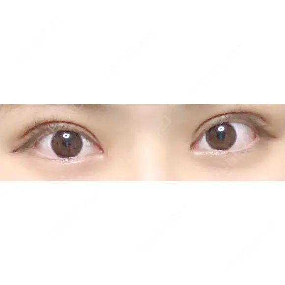 二重切開 / 目頭切開 東京イセアクリニック DAY 67 メイン用
