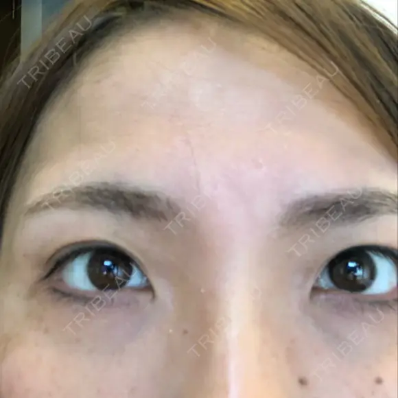 二重切開 / 眼瞼下垂（切開） / 上まぶたたるみ取り 湘南美容クリニック 高田馬場院 DAY 108 メイン用