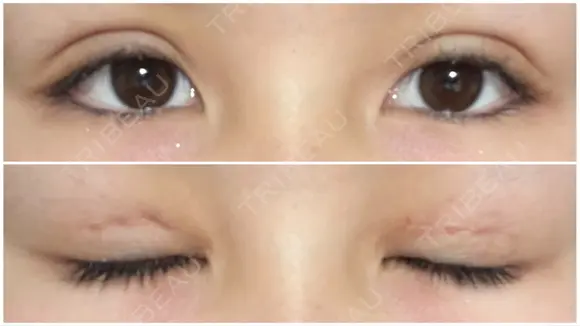 二重切開 / 上まぶたたるみ取り / 目元修正 サラ美容外科 DAY 11 メイン用