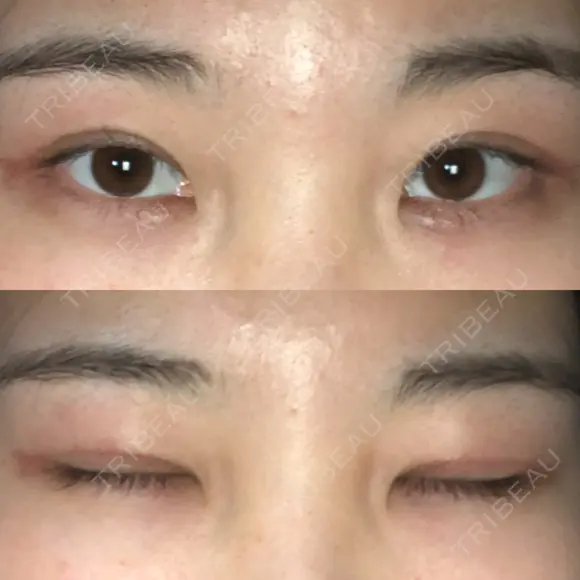 二重切開 / 眼瞼下垂（切開） ブリスクリニック形成外科・美容外科・美容皮膚科 福岡 DAY 29 メイン用