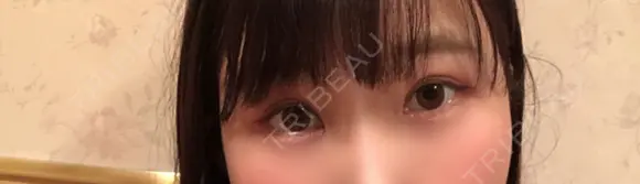 二重切開 / 眼瞼下垂（切開） ブリスクリニック形成外科・美容外科・美容皮膚科 福岡 DAY 29 メイン用