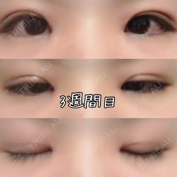 目頭切開 / 眼瞼下垂（切開） 白山クリニック 大分 DAY 21 メイン用