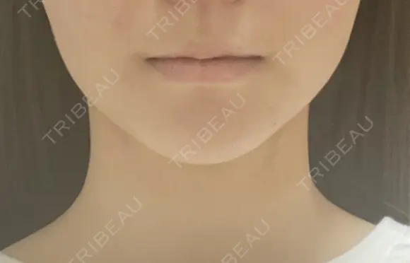 脂肪吸引（顔） Mods Clinic（モッズクリニック） 東京院 DAY 13 メイン用