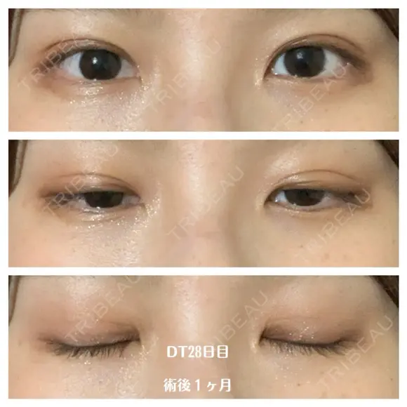 二重埋没 湘南美容クリニック 藤沢院 AFTER メイン用