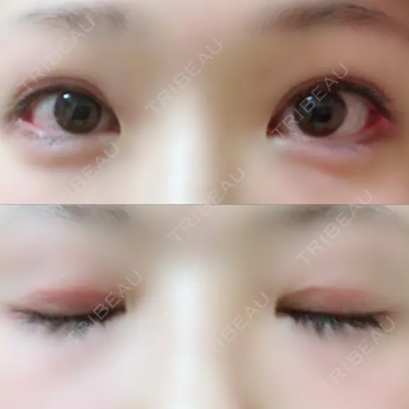 二重切開 / 眼瞼下垂（切開） / 目尻切開 ジュエリー美容外科 DAY 61 メイン用