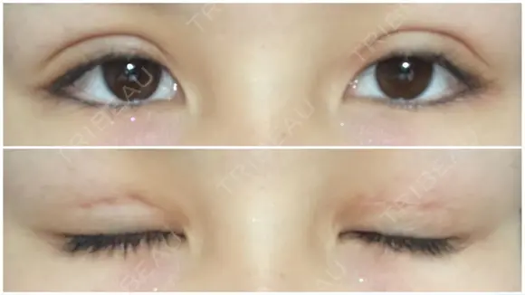 二重切開 / 上まぶたたるみ取り / 目元修正 サラ美容外科 DAY 12 メイン用