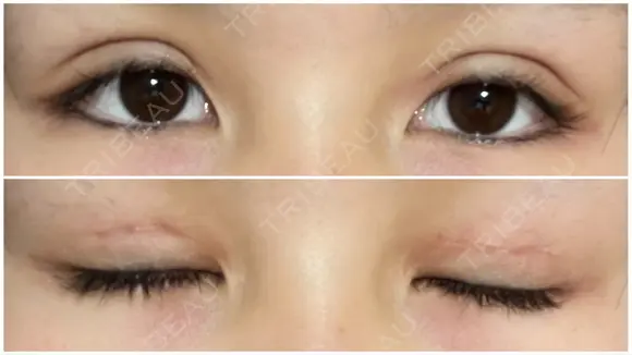 二重切開 / 上まぶたたるみ取り / 目元修正 サラ美容外科 DAY 13 メイン用