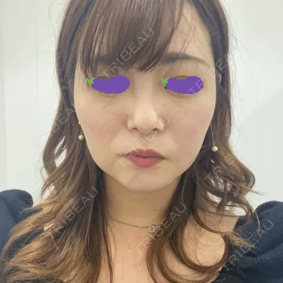 脂肪吸引（顔） 表参道スキンクリニック 表参道院 DAY 230 メイン用