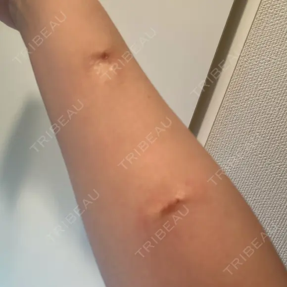 傷跡修正 酒井形成外科 DAY 15 メイン用