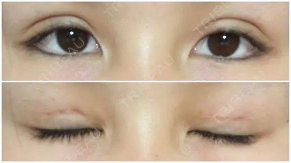 二重切開 / 上まぶたたるみ取り / 目元修正 サラ美容外科 AFTER メイン用