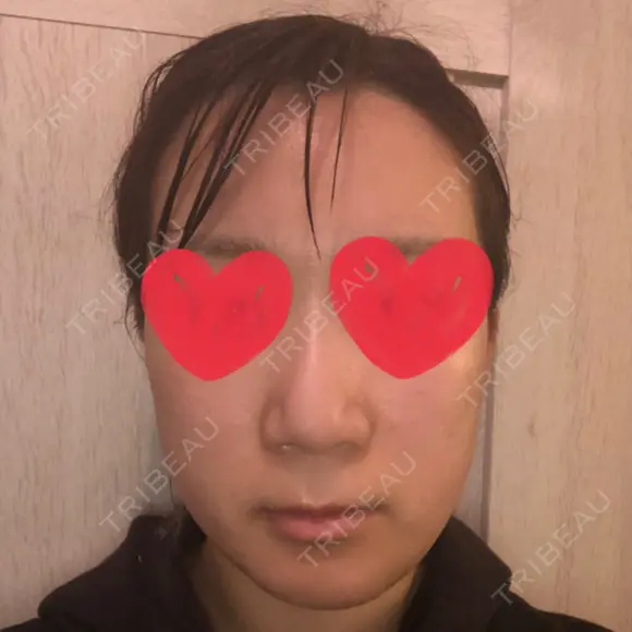 骨切り（あご） / 骨削り（エラ） リラ・クラニオフェイシャル・クリニック AFTER メイン用