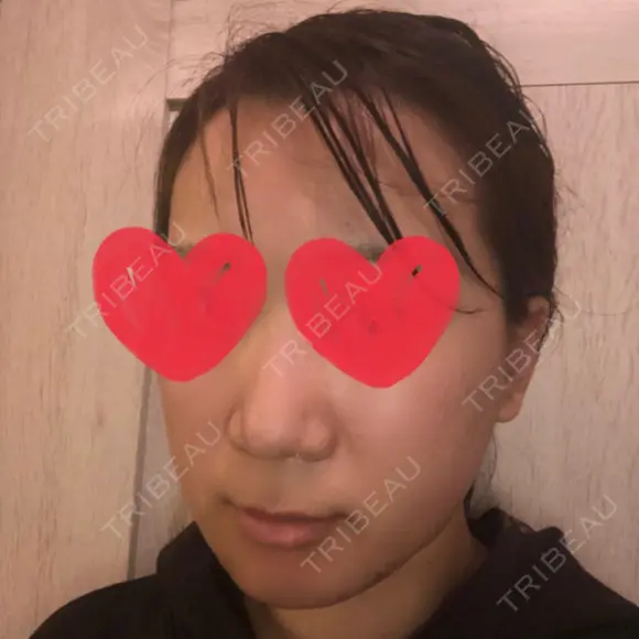 骨切り（あご） / 骨削り（エラ） リラ・クラニオフェイシャル・クリニック DAY 181 メイン用