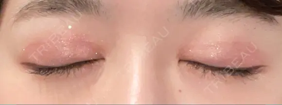 二重切開 恵聖会クリニック 心斎橋院 DAY 119 メイン用