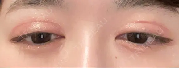 二重切開 恵聖会クリニック 心斎橋院 DAY 119 メイン用