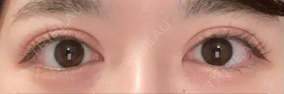 二重切開 恵聖会クリニック 心斎橋院 AFTER メイン用