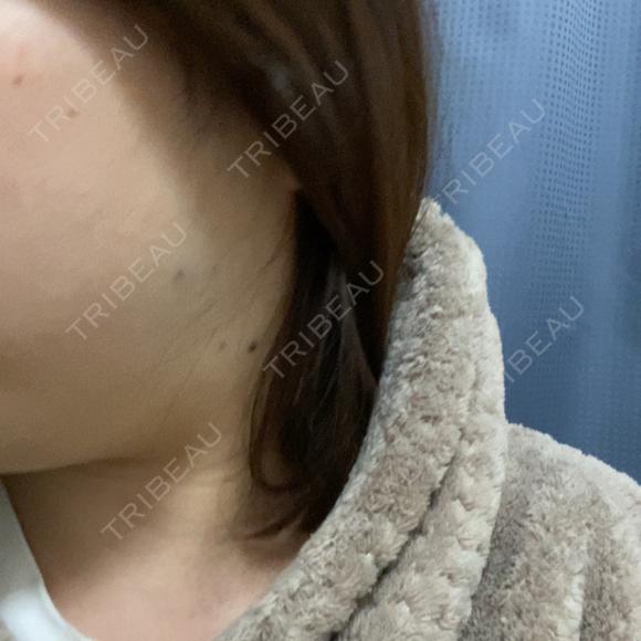 ボトックス（エラ・小顔） TCB東京中央美容外科 立川院 DAY 0 メイン用