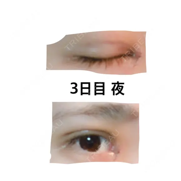 二重埋没 / 目頭切開 かめい美容クリニック宇都宮 DAY 3 メイン用