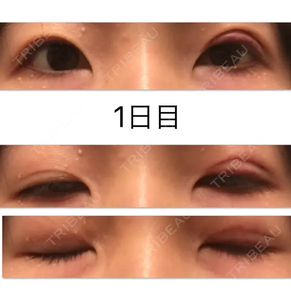 二重埋没 高須クリニック 大阪院 DAY 1 メイン用