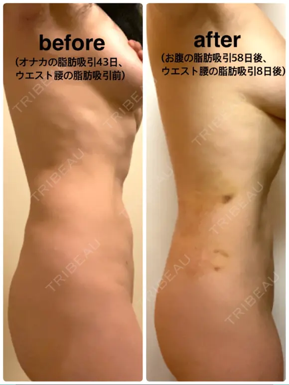 脂肪吸引（お腹） / 脂肪吸引（お尻） / その他（ボディ） 石倉クリニック 水戸院 DAY 8 メイン用
