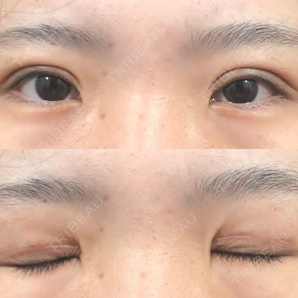二重切開 城本クリニック 福岡院 DAY 49 メイン用
