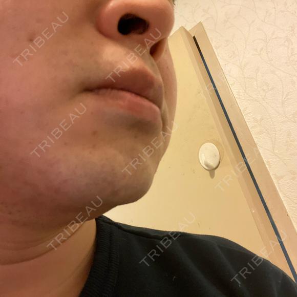 医療脱毛（顔） 自由が丘クリニック DAY 1 メイン用