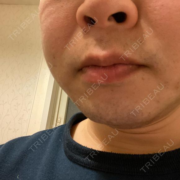 医療脱毛（顔） 自由が丘クリニック DAY 2 メイン用