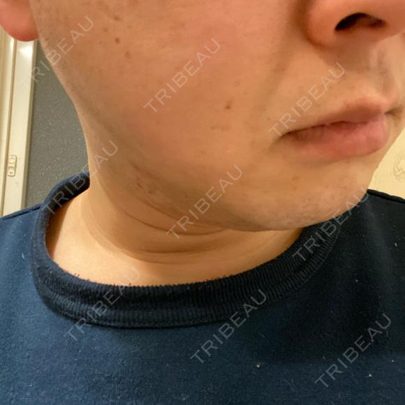 医療脱毛（顔） 自由が丘クリニック DAY 2 メイン用