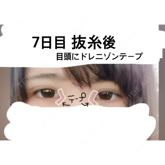 二重埋没 / 目頭切開 かめい美容クリニック宇都宮 DAY 7 メイン用